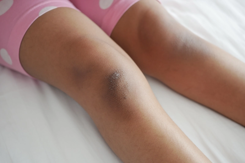 Knee Whitening Treatment in League City, TX