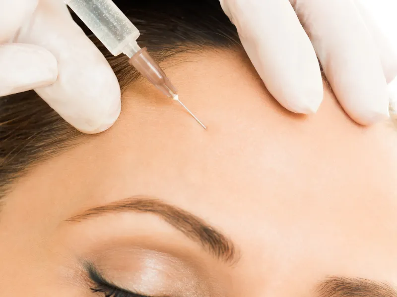 forehead lines treatment with Botox