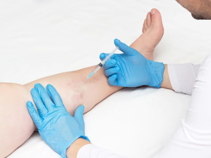 Varicose Veins Treatment option